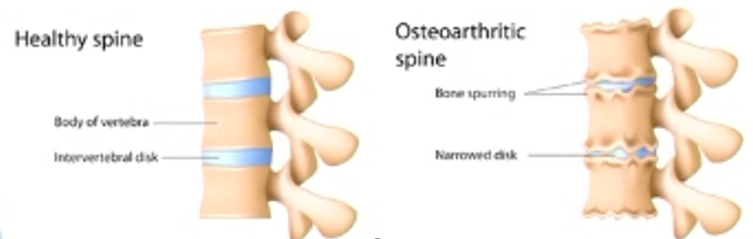 Kenali Berbagai Penyebab Terjadinya Penyakit Osteoartrithis atau Penyakit Nyeri Sendi dan saran Solusinya
