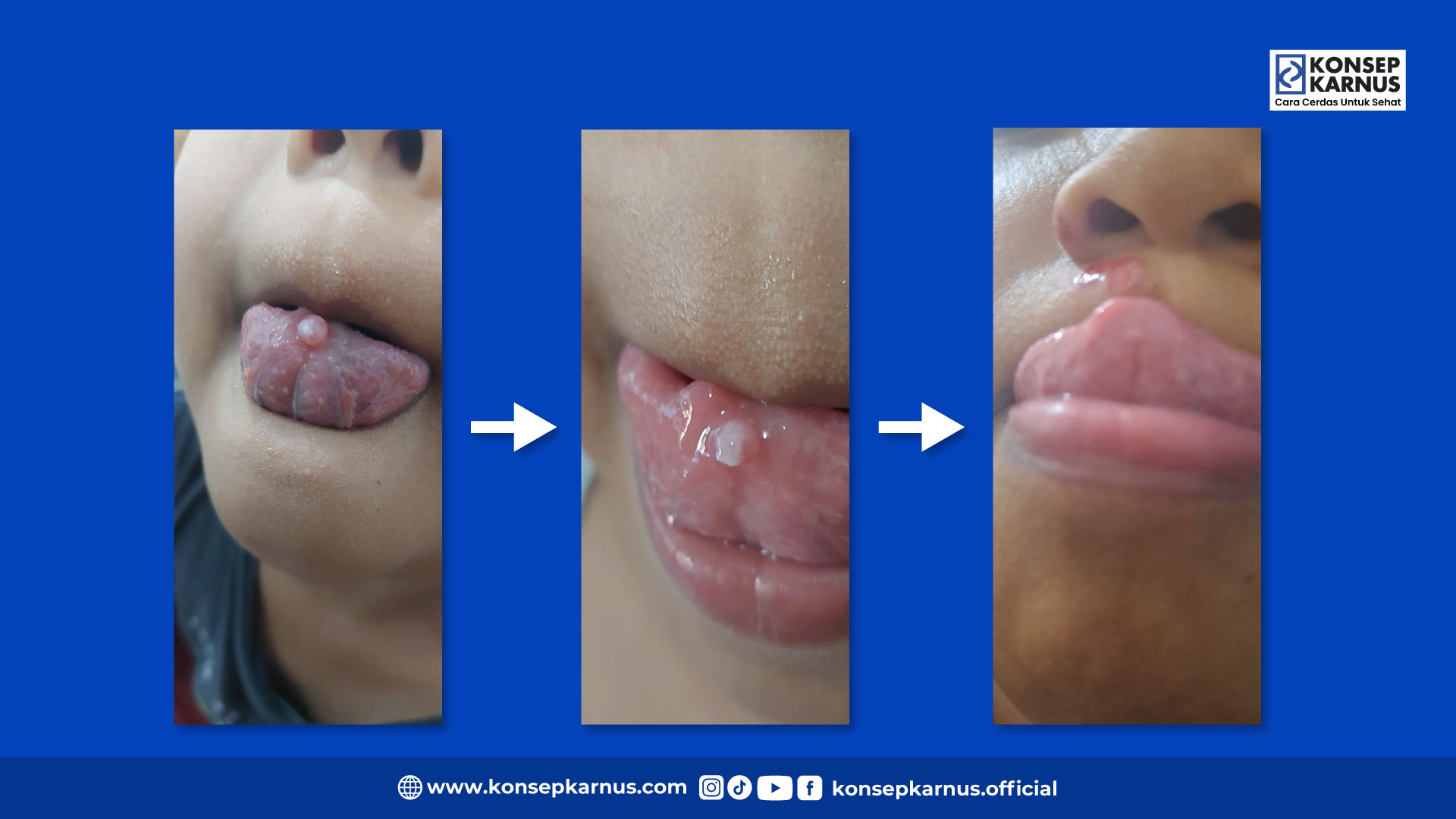 kista mukosa lidah konsep karnus